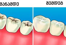 8 პასუხი კბილებთან დაკავშირებულ ყველაზე ხშირად დასმული კითხვებზე - პრაქტიკოსი სტომატოლოგისგან
