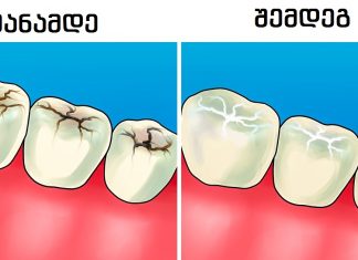 8 პასუხი კბილებთან დაკავშირებულ ყველაზე ხშირად დასმული კითხვებზე - პრაქტიკოსი სტომატოლოგისგან