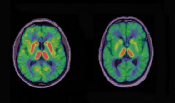 მარცხნივ: ჯანსაღი ადამიანის ტვინი; მარჯვნივ: პარკისონით დაავადებული ადამიანის ტვინი
