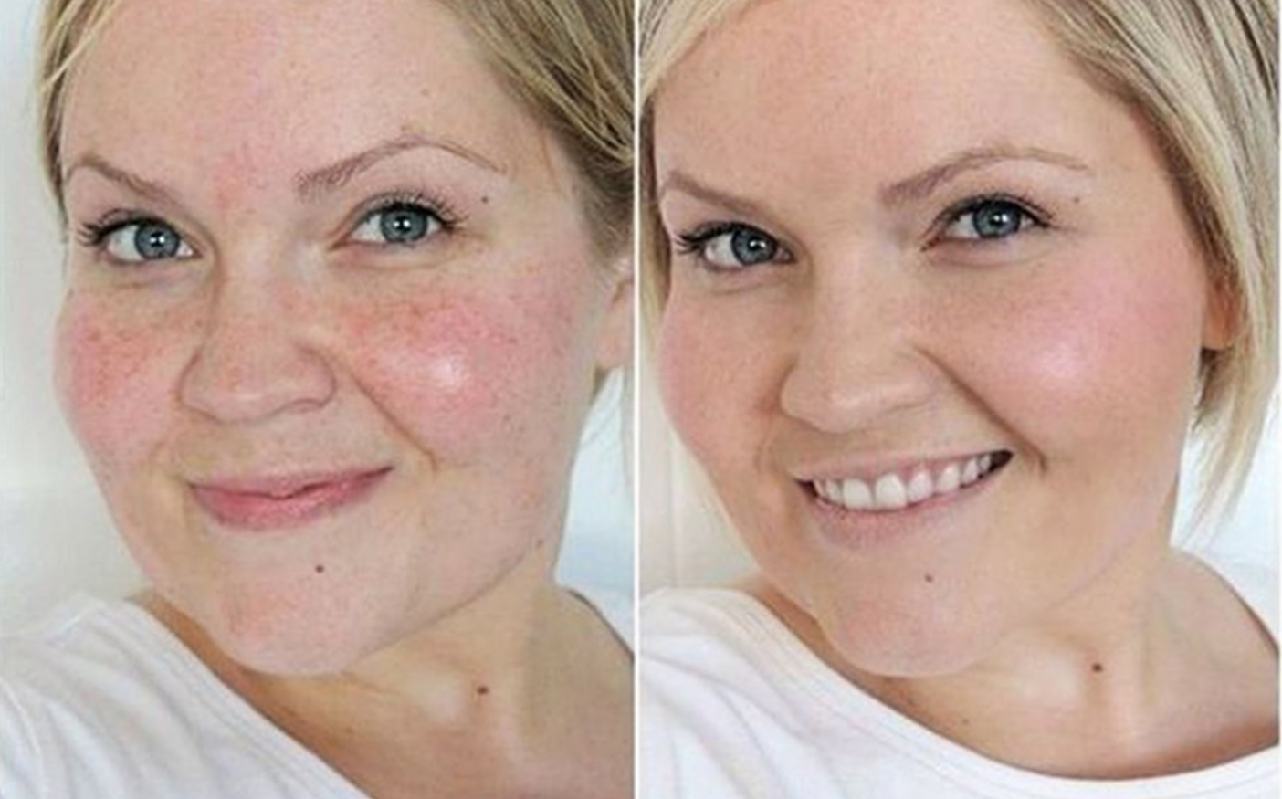 Пилинг для лица. Пигментация на лице до и после. Можно делать пилинги летом