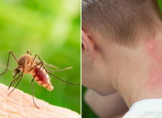 თუ კოღოს ნაკბენის შემდეგ კანი გისივდებათ, თქვენ შეიძლება სკიტერის სინდრომი გქონდეთ
