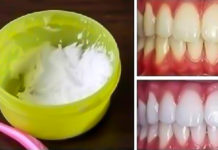 როგორ გავითეთროთ კბილები სახლის პირობებში მხოლოდ 3 წუთში. 100 %-იანი შედეგი
