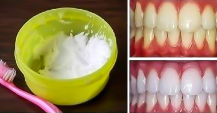 როგორ გავითეთროთ კბილები სახლის პირობებში მხოლოდ 3 წუთში. 100 %-იანი შედეგი