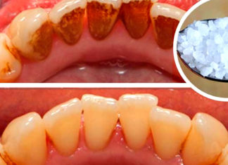 ეს საშუალება ძალიან გაყვითლებულ კბილებსაც გაათეთრებს და კბილის ქვას მოგაშორებთ. შესანიშნავი ეფექტი
